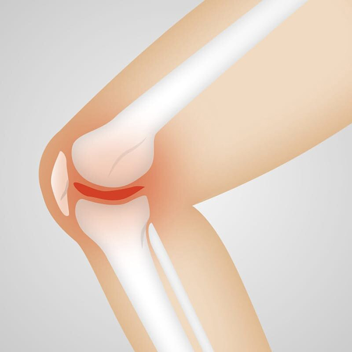 무릎이아플때 관절염 통증