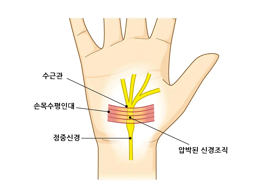 손목터널증후군 손끝 저림 증상 손목 통증 수근관증후군
