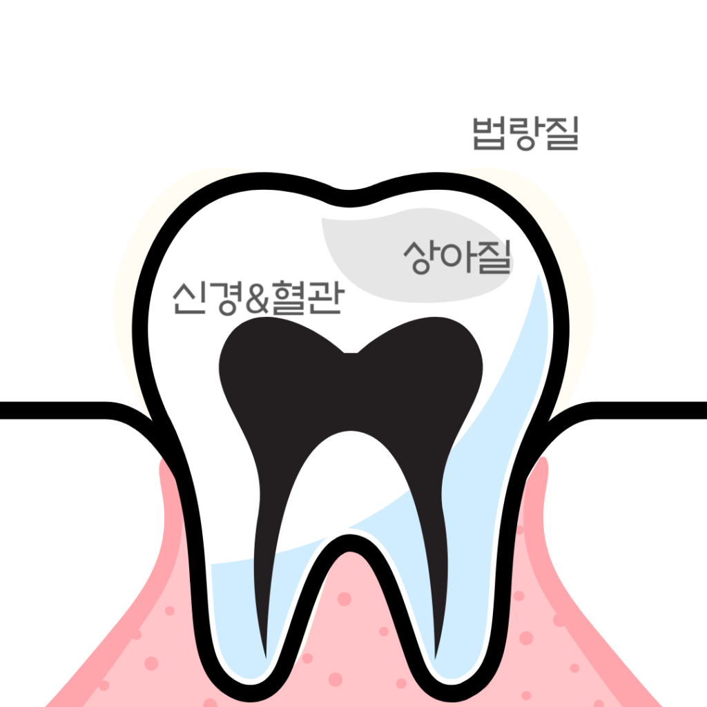 충치 크라운 치과치료 치아 법랑질 상아질 신경 혈관