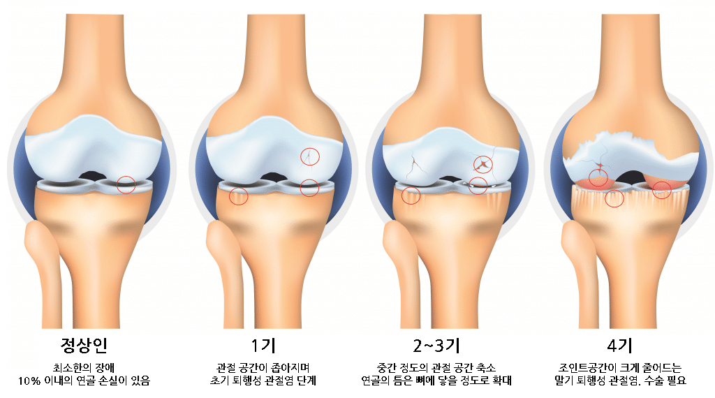 퇴행성 무릎 관절염 4단계