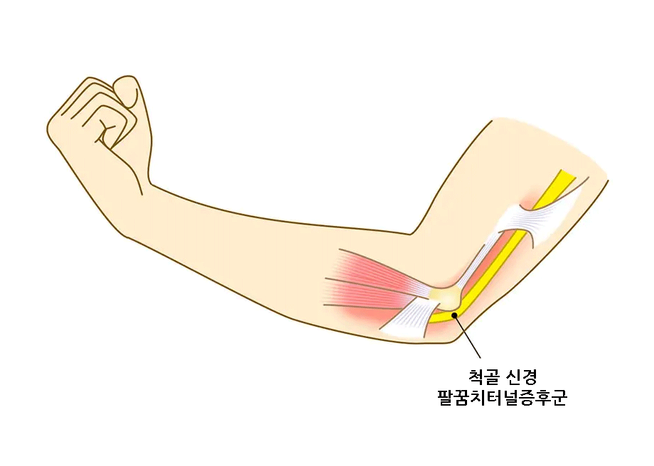 팔꿈치터널증후군 새끼손가락 팔 팔꿈치