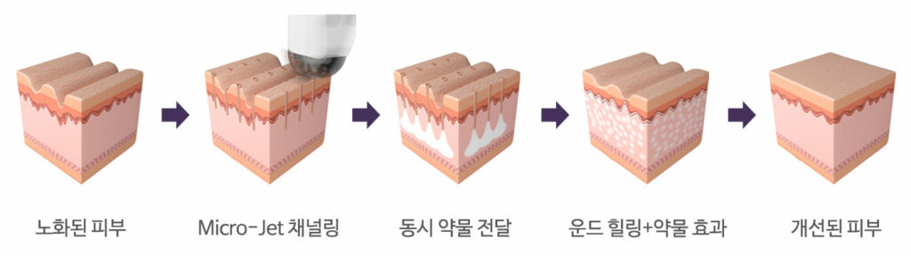미라젯 튼살 쥬베룩 가격 치료 효과 여드름 흉터 모공 레이저 콜라겐